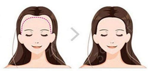 北京做植发医院排名榜五强公布