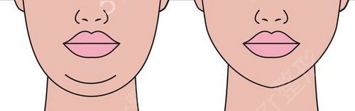 全国磨骨前三的公立整形医院排名发布