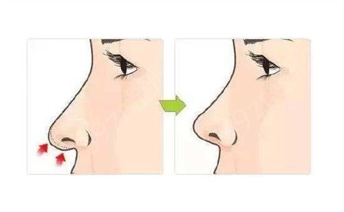 上海容妍李昕医生鼻部手术怎么样