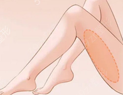 长沙哪家医院做大腿吸脂好