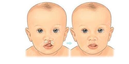 北大口腔医院做唇裂修复*