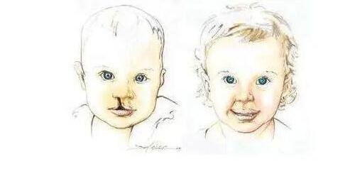 北大口腔医院做唇裂修复*