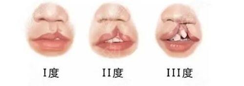 北大口腔医院做唇裂修复*