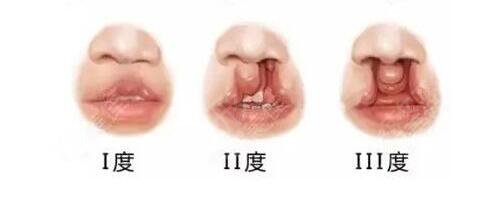 北大口腔医院做唇裂修复*