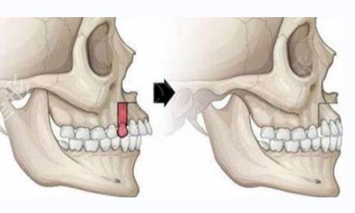 上海华美和九院哪个磨骨技术好