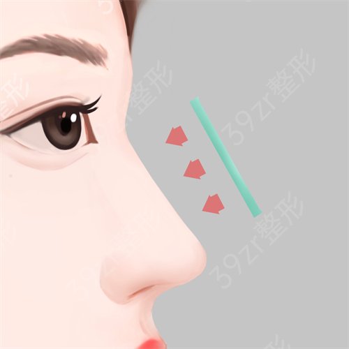 上海九院玻尿酸隆鼻挂什么科