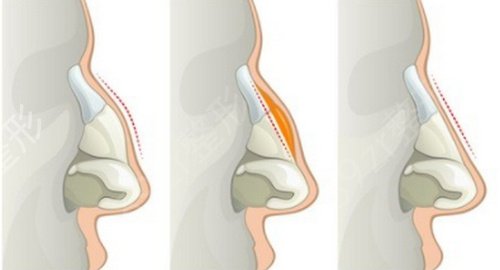 成都隆鼻修复权威医生哪个好