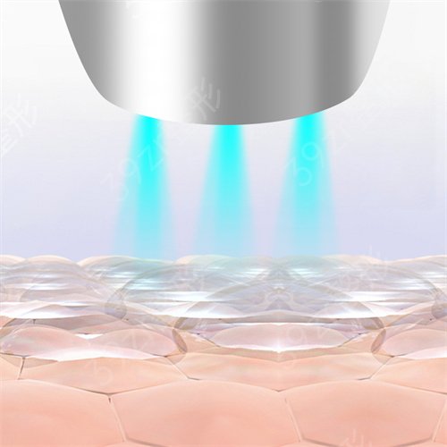 光子嫩肤多少钱