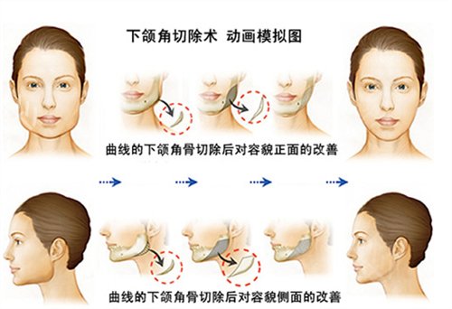 上海下颌角整形哪家好