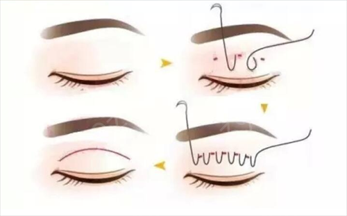 �����ĸ�ҽԺ��˫��Ƥ��