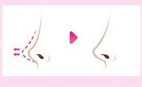 *鼻王医生排名榜权威专家揭晓