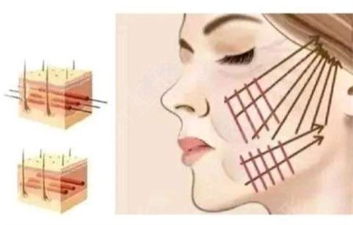 北京热玛吉认证医院正规排名前五