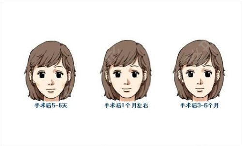 上海首尔丽格磨骨好不好 看看我的术后恢复照片就知道