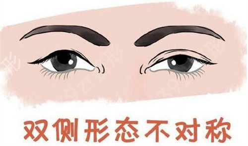广东双眼皮修复医生排行榜前三权威发布