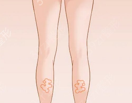 广州美莱和华美吸脂哪个好点