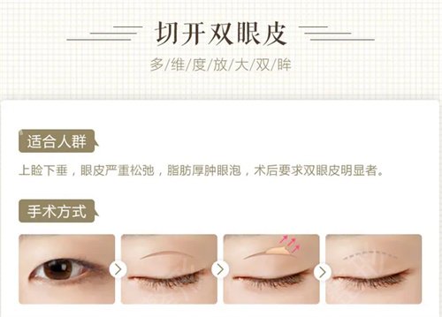 在温州加美做了个美美的双眼皮