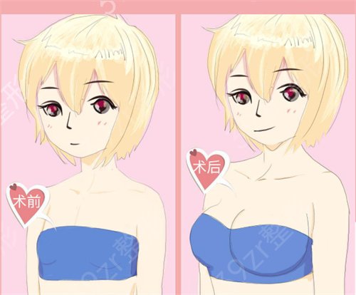 广州第二人民医院隆胸怎么样