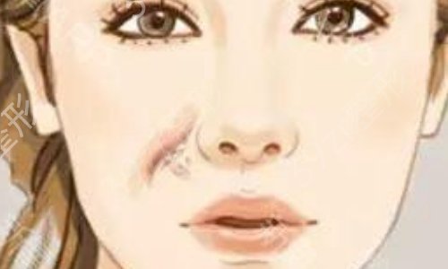 北医三院整形科唇部整形多少钱