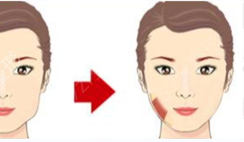 广州磨骨医院哪家好