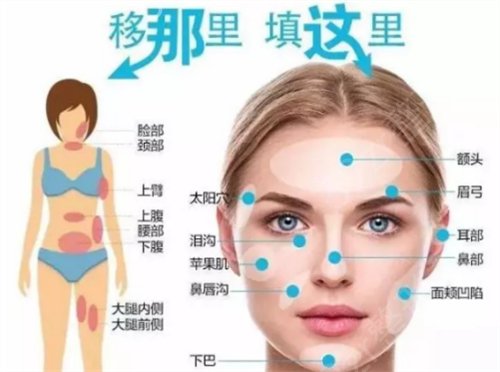 南京华美沈正宇脂肪填充面部怎么样