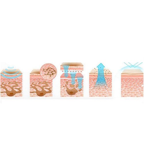 三甲医院点阵激光价格以及需要注意什么