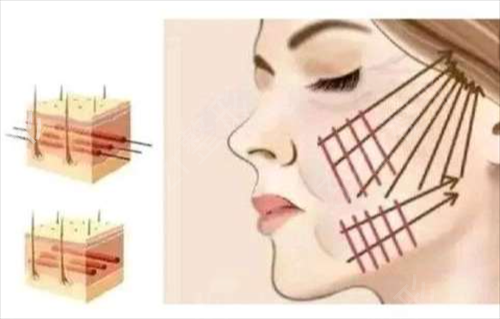 广州做热玛吉哪个医院专业