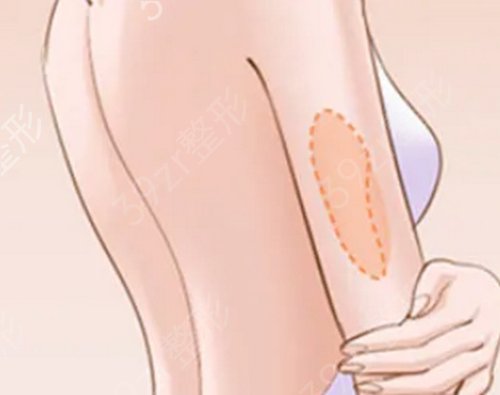 福建医科大学附属第二医院整形科价格表_手臂抽脂案例