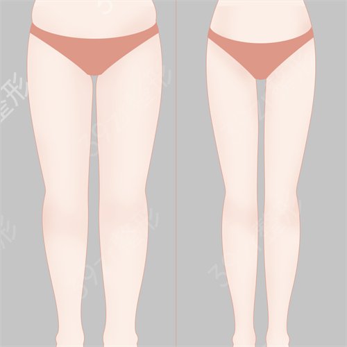 成都艺星吸脂怎么样_价格表(价目表)_瘦大腿案例果图_成都艺星整形项目收费明细