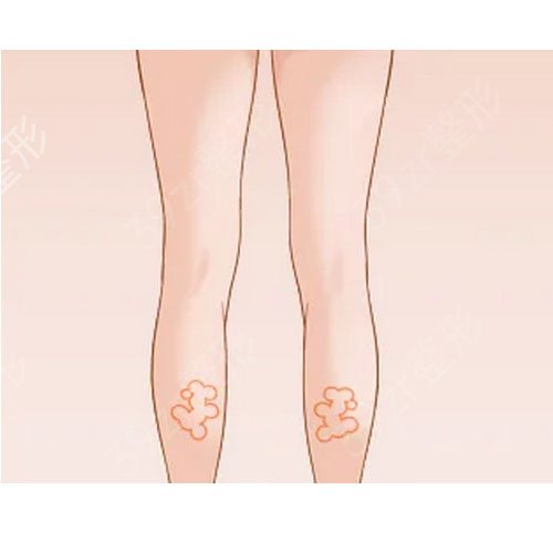 昆明华美美莱吸脂怎么样