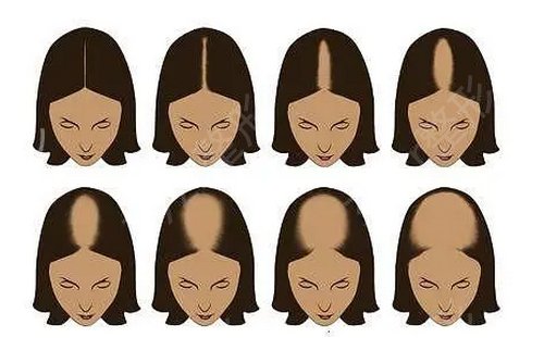 保定华美医院植发案例详情及价格表公开