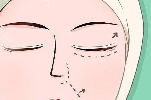 想割双眼皮去哪里好