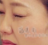 ��botoxȥ��β����������������Ů��