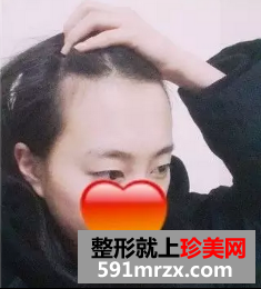 种植头发前后效果展示 种植头发案例分享