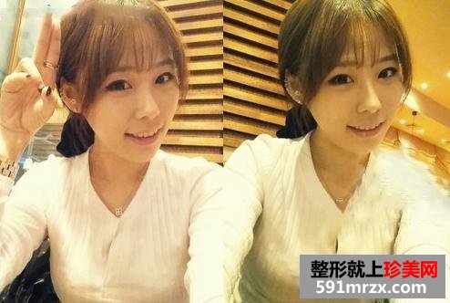 改脸型前后对比照片 我的改脸型整形分享